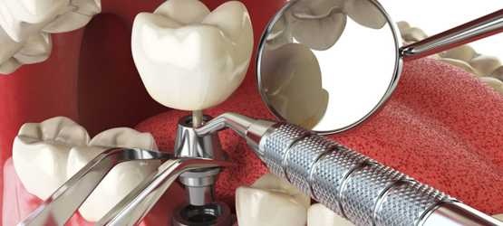 Implant-Dentistry