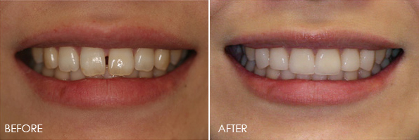 veneers1